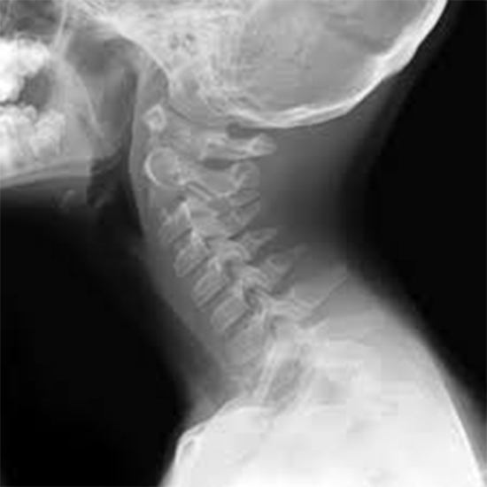 X-Ray Cervical Spine Neutral Position